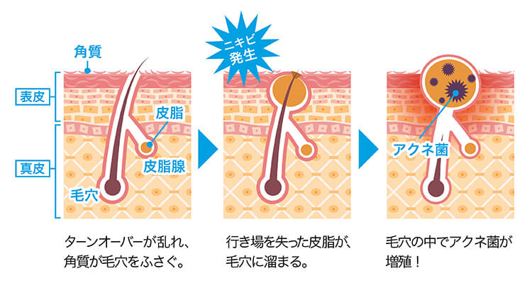 大人ニキビの原因は「乾燥」？思春期ニキビとの違いやケアの方法を紹介｜敏感肌研究室｜Arouge（アルージェ）