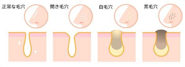 毛穴が目立つ原因とは 改善方法を紹介 敏感肌研究室 Arouge アルージェ